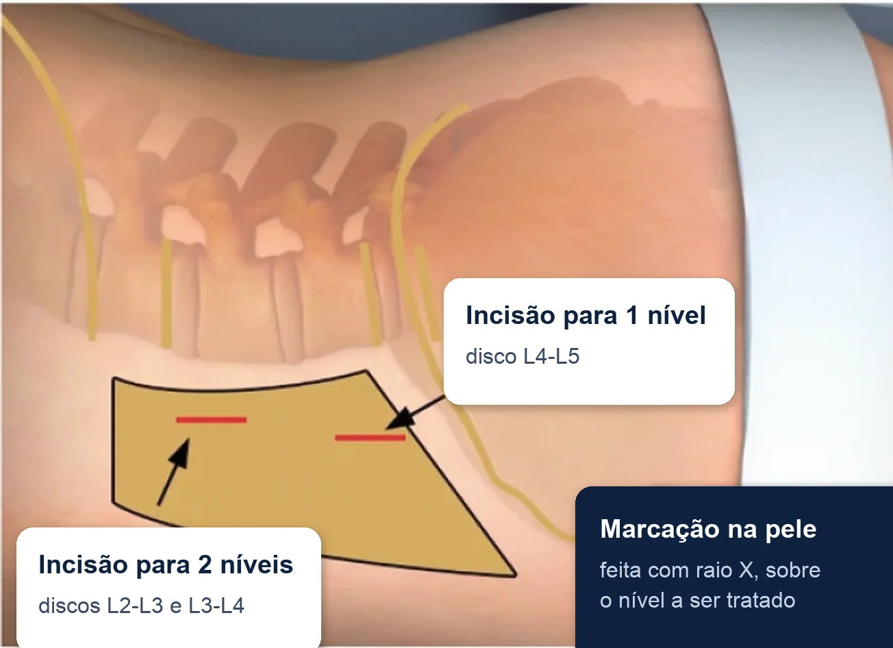 Ilustração da coluna lombar vista de lado, com a marcação da incisão na lateral do abdome para um ou dois níveis