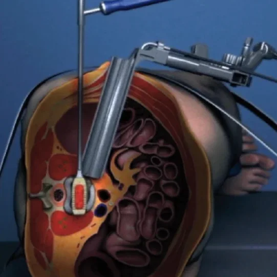 Ilustração em corte do abdome mostrando o afastador chegando ao disco pela lateral, com o paciente deitado de lado
