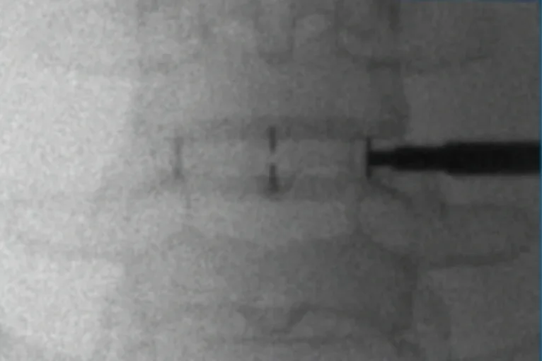 Raio X de frente durante a cirurgia, com o espaçador no espaço do disco