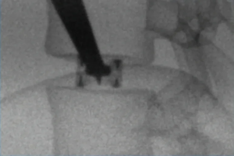 Raio X de perfil durante a cirurgia, com o espaçador no espaço do disco