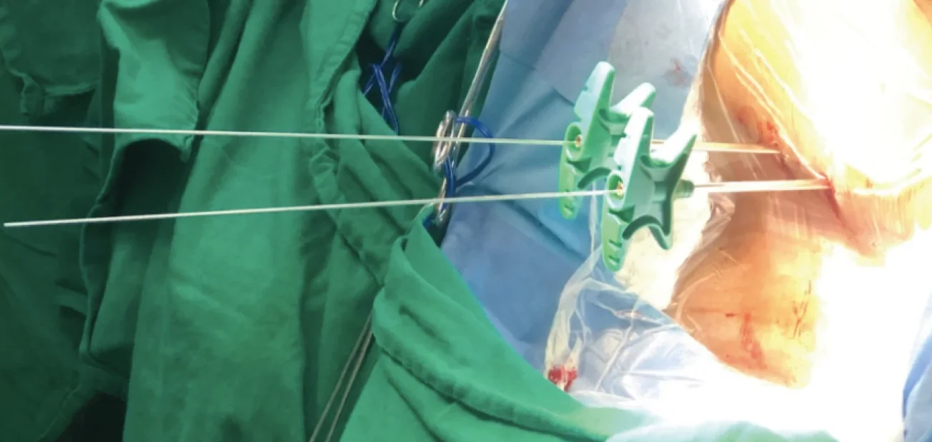 Foto da cirurgia: fios-guia e instrumentos dos parafusos percutâneos inseridos pelas costas, com o paciente ainda deitado de lado